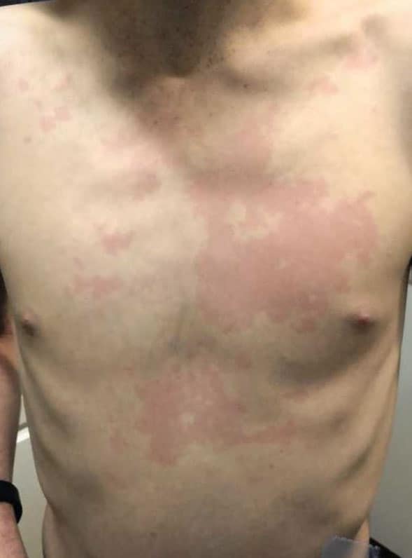 Rash caused from mold on Camp Pendleton military base in San Diego